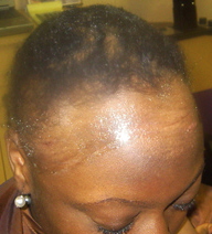 alopeciafront