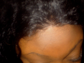 alopeciafrontafter